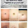 When you had your fallopian tubes tied, they w. 1