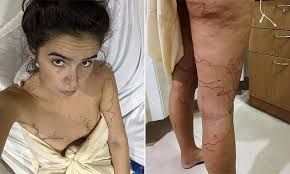 Aussie tourist's urgent warning after near brush with death at a beach in  Thailand left her in hospital for a month