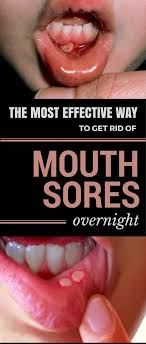 The Most Effective Way To Get Rid Of Mouth Sores Overnight Whatisthepurposeoforalcare In 2020 Mouth Sores Canker Sore Sore In Mouth Remedies