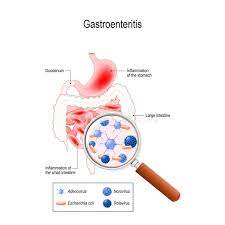 Gastroenteritis can be very unpleasant, but it usually clears up by itself within a week. Gastroenteritis Vektor Abbildung Illustration Von Verdauung 124275866