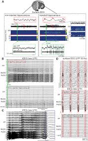 Having the quality of or containing reminiscence. Operational Definition Of Paroxysmal Hpds A Example Of A Whole Train Download Scientific Diagram