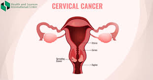 The cancer might invade other tissues and organs. What Are The Symptoms Of Cervical Cancer Hti Centers Medical Tourism Center