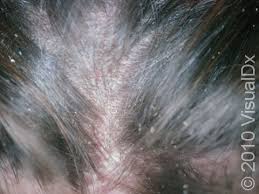 Image result for white scabs on the head in children