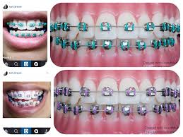 Use Bracemate To Help You Pick Colours For Your Braces Thanks Karii Braces For Letting Me Use Her Photos Bra Dental Braces Braces Colors Cute Braces Colors