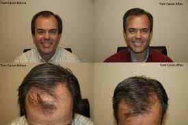 Maybe you would like to learn more about one of these? Nesn Tv Personality Tom Caron Hair Transplant
