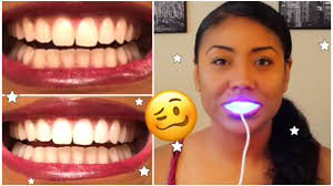 How long does it take for teeth bleaching to work? I Tried Smile Direct Teeth Whiten And This Is What Happened Thorough Review W Pics Youtube