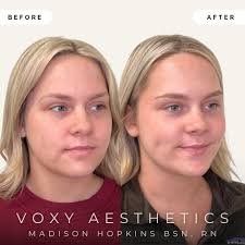 Before & After ✨ Take a look at this stunning transformation! Our beautiful  client came in for Filler to her chin, lower face, and lips, plus a Tox  treatment by our injector