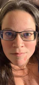 I have pulmonary and lymph nodes sarcoidosis. In the last month, I have  developed minute little bumps