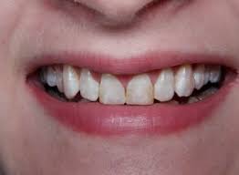 We did not find results for: How Have Dental Veneers Changed Over Time From 123dentist