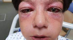 El Peligroso Reto De Youtube Que Le Causo Heridas Vistas En Los Pilotos De Combate A Un Nino De 11 Anos Bbc News Mundo