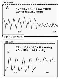 Com o tempo, o pericárdio perde sua elasticidade e fica rígido. Braz J Cardiovasc Surg Forma Inusitada De Pericardite Cronica Constritiva Idiopatica