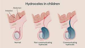 Hydrocele in children