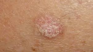 Image result for Oncinotis