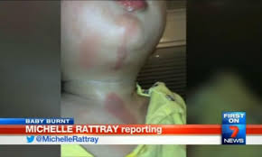 Toddler Gets Second Degree Burns At Daycare Kidspot