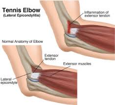 How to view the anatomical labels. Tennis Elbow Treatment Surgery Providence Orthopaedics
