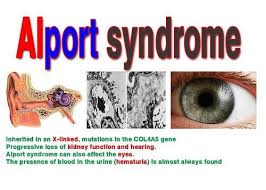 We did not find results for: Alport Syndrome Snhl Progressive Renal Disease Alport Syndrome Syndrome Renal Disease