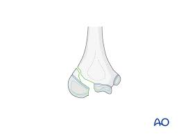 Image result for Lateral Condyle Fracture