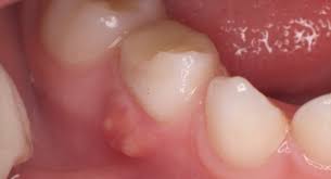 Gum abscesses and gum boils: An Abscess On The Gum Abscess What To Do Treatment Of A Purulent Abscess On The Gum At Home