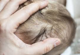 Image result for Cradle Cap
