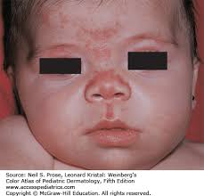 Image result for Nevus Simplex