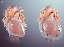Pericarditis es una afección en la cual la cubierta similar a un saco alrededor del corazón (pericardio) resulta inflamada. Pericarditis What Is It Symptoms Causes Prevention And Treatment Top Doctors