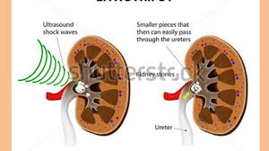 Dr Davis Lamson Nd Kidney Disease Kidney Stones Symptoms Kidney Cyst Kidney Disease