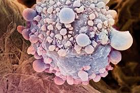 In some pancreatic cancer patients, there can be a troubling large collection of fluid in the abdominal cavity. Blood Test Could Catch Pancreatic Cancer Before It S Too Late New Scientist