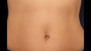Exista o serie de sfaturi după operatia laparoscopica de hernie pe care fiecare pacient operat ar trebui sa le cunoască, sfaturi care vor face mai ușoara trecerea de la ipostaza de pacient cu patologie de perete abdominal, la ipostaza fostului pacient devenit sănătos din nou după operație. Ce Se Intampla Dupa Operatia De Hernie Cu Plasa Dr Stefan Jianu Clinica Proestetica Youtube