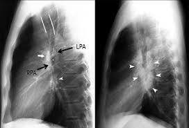 Chest X Ray Lateral View Of A Normal Hilum Pulmonary Arteries Download Scientific Diagram