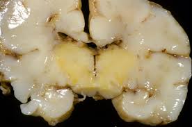 Image result for Kernicterus