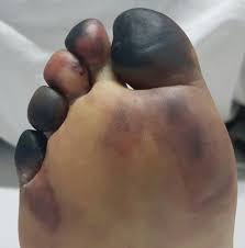 Image result for toe black diabetes