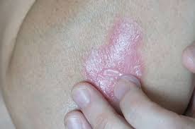 Image result for psoriasis
