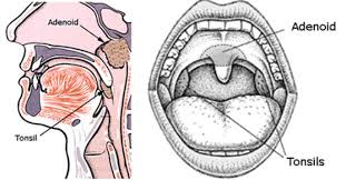 He may tell you not to eat what are the risks of a tonsillectomy? Tonsil Removal Tonsil And Adenoid Surgery Ent Clinic