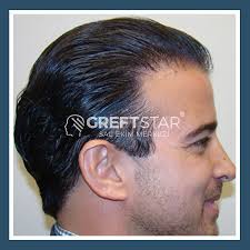 Greft Star Adli Kullanicinin Sac Ekimi Samsun Panosundaki Pin Sac Galeri