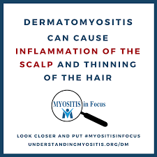 Pin On Myositis Awareness