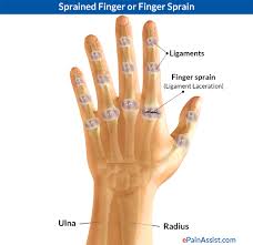 Dislocated fingers are fairly common injuries that occur when a bone slips out of alignment. Sprained Thumb Or Skier S Thumb Types Causes Signs Symptoms Treatment Exercises