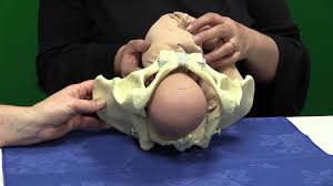 Image result for Manual Rotation in Occipitoposterior Presentation