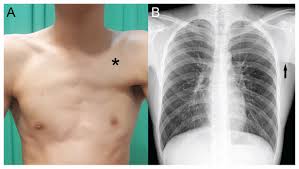 Poland Syndrome In An 18 Year Old Man Cmaj