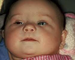 Brightest Future for Babies with Down Syndrome