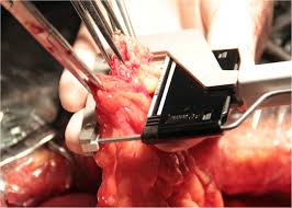 Colonic resection with primary anastomosis and defunctioning ileostomy. Ileocolonic Anastomosis After Right Hemicolectomy For Colon Cancer Functional End To End Or End To Side World Journal Of Surgical Oncology Full Text