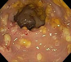 What causes clostridium difficile colitis? Clostridium Difficile Wikem