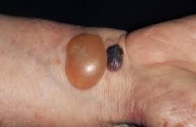 Blood blister on foot under skin. Bullous Pemphigoid Nhs