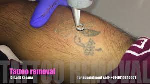 We would like to show you a description here but the site won't allow us. Tattoo Removal By Dr Lalit Kasana In Hindi By Dr Lalit Kasana
