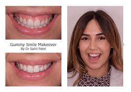 These gummy smile treatments are performed by dentists or maxillofacial surgeons where they cut out the excess gum tissue in a procedure called a. Gummy Smile Makeover Harley Street Smile Clinic