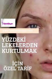 Sivilce Kizarikliklarina Ne Iyi Gelir Cilt Bakimi Cil Doktorlar