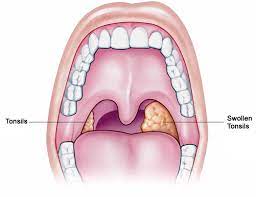 In some cases, children are sent home the same day as the operation and recovery time is one to two weeks. Pros And Cons Of Singing With Or Without Tonsils Throga