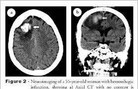 Efns guideline on the treatment of cerebral venous and sinus thrombosis. Cerebral Venous Sinus Thrombosis In Saudi Arabia Semantic Scholar