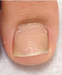 Image result for Pitting nails feet