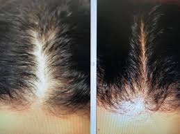 Apr 18, 2020 · the longer the hair stays in this phase, the more new hair fibers are created. Hair Restoration For Women And Men Rejeune Md Wellness And Aesthetics