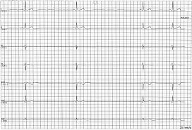 Sinus Node Dysfunction Wikipedia